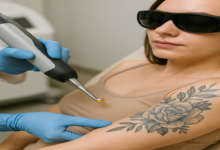 Tattoo removal: Why a professional approach prevents scarring