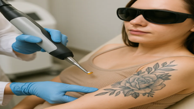 Tattoo removal: Why a professional approach prevents scarring